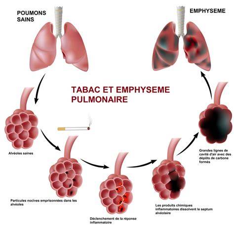 principe du traitement et maturation pulmonaire fœtale