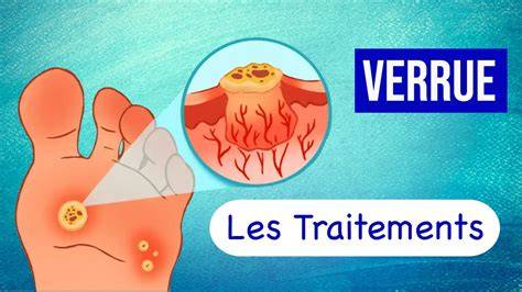 illustration-types-verrues-main-pied