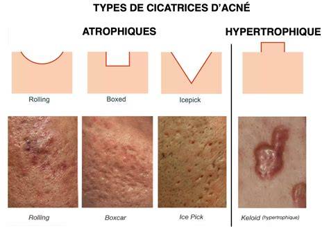 illustration types de cicatrices et options de traitement