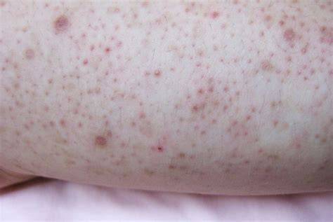 Causes des boutons sur les jambes