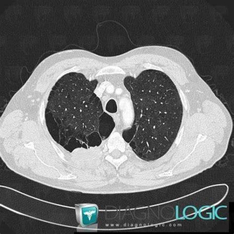 Types d’emphysème pulmonaire au scanner