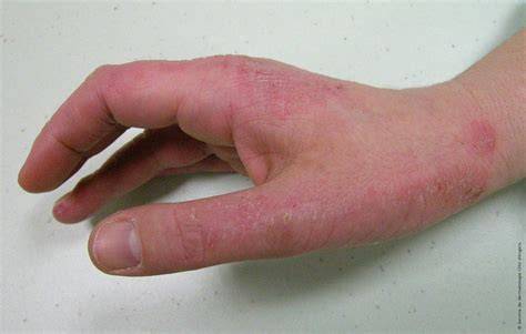 dermatite sous bague doigt rouge