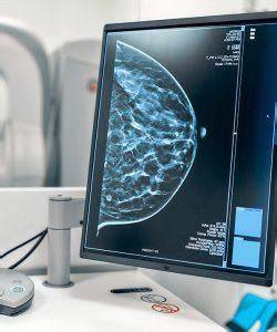 Déroulement compression sein mammographie