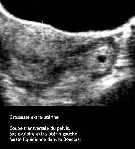 Échographie endovaginale grossesse précoce